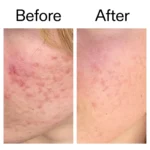 Azealic Acid Serum B A Ppage 2000 x 2000 1600x (1)